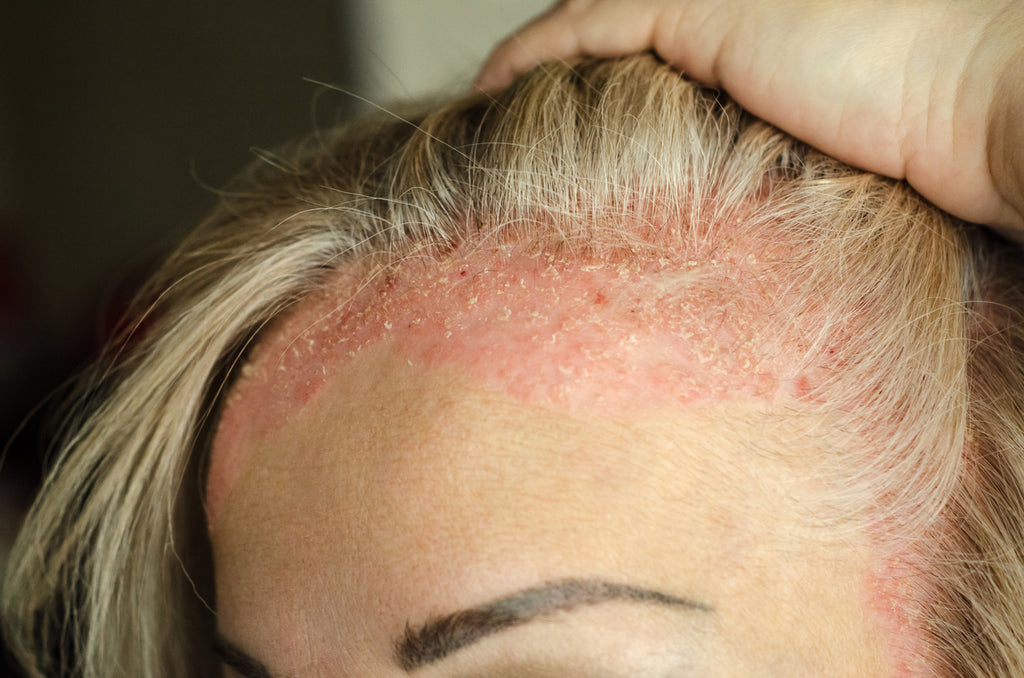 LA PERTE DES CHEVEUX : L'ECZÉMA ET LE PSORIASIS